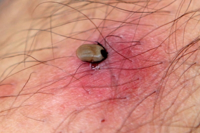 Novi zdravstveni rizik u Europi: Otkriven virus u krpeljima koji cirkulira već 20 godina