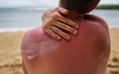 Neujednačen ten tokom ljeta: Dermatolozi otkrivaju kako ga spriječiti