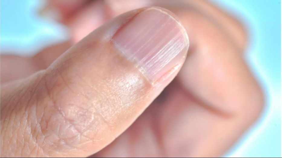 Tamna linija na noktu može ukazivati na melanom