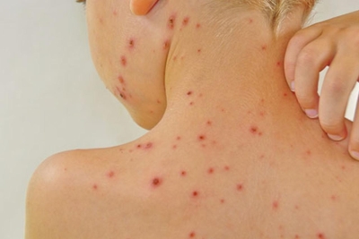 LIJEČNICI UPUTILI OZBILJAN APEL Pojavile se ospice u HNŽ-u, visokozarazna i opasna bolest