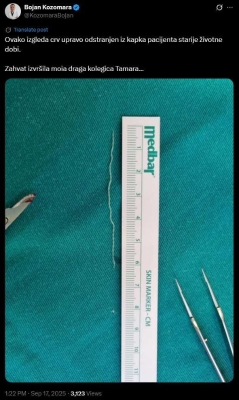 Banjalučki doktor objavio fotografiju: Iz kapka odstranjen crv od 6 cm (Foto)