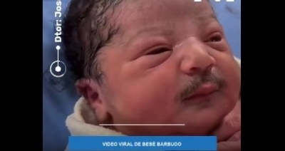 Beba rođena sa brkovima i bradom, stručnjaci objasnili o čemu je riječ