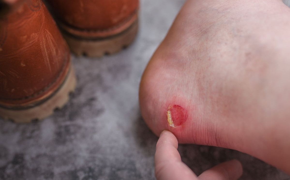 Neugodni i bolni: Riješite se žuljeva na nogama na prirodan način