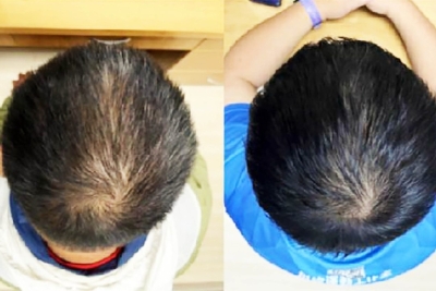 TAJNI RECEPT ZA GUSTU KOSU: Tim stručnjaka izumio serum koji rješava problem ćelavosti bez agresivne hemije i skalpela